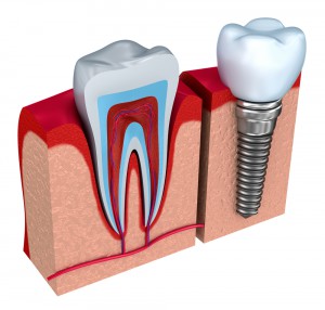 Toronto Dental Implant