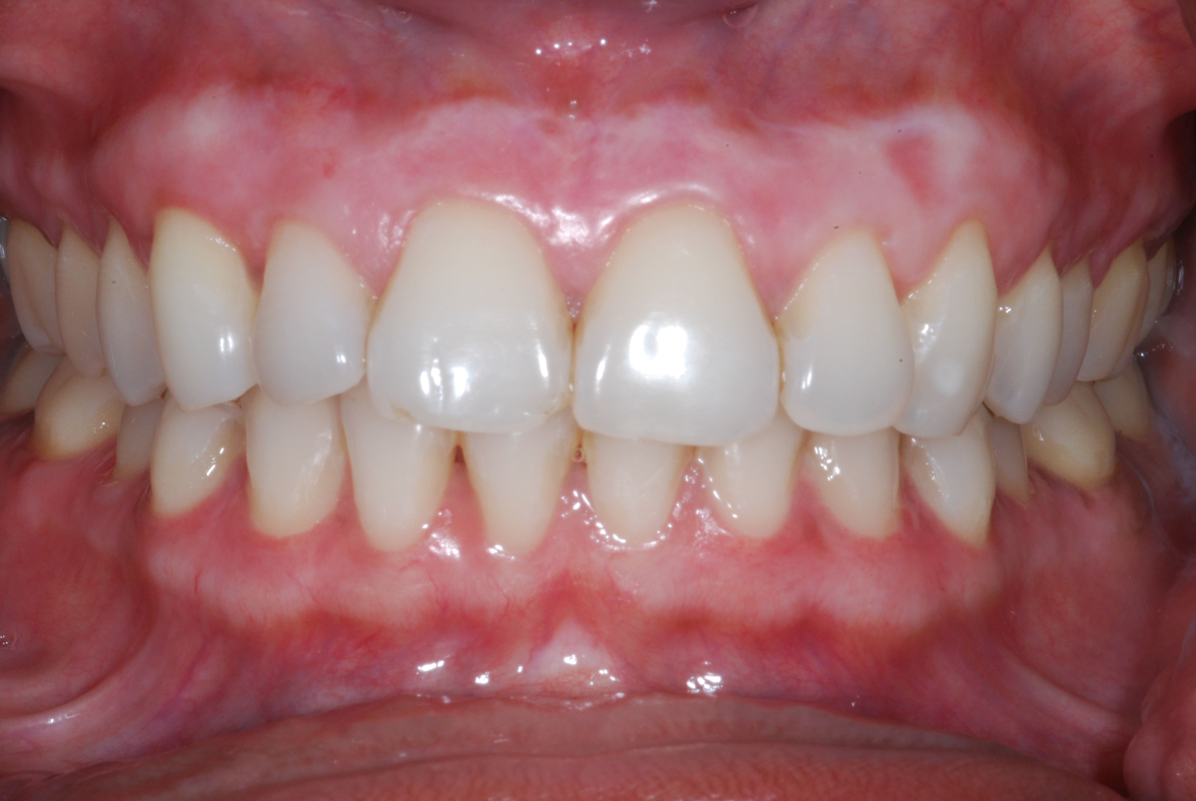 teeth whitening white spots on gums