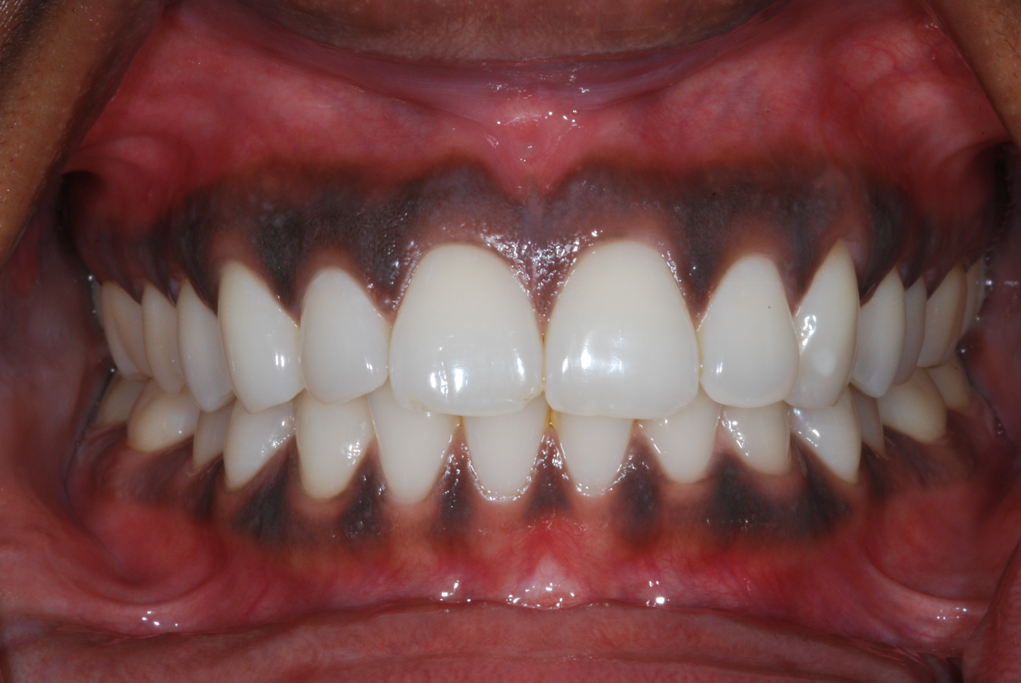 Gum Bleaching - is it for you? Would you like pinker gums?